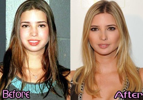 ivanka-trump-before-and-after-plastic-surgery-2